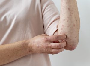 skin-allergy-person-s-arm (1)